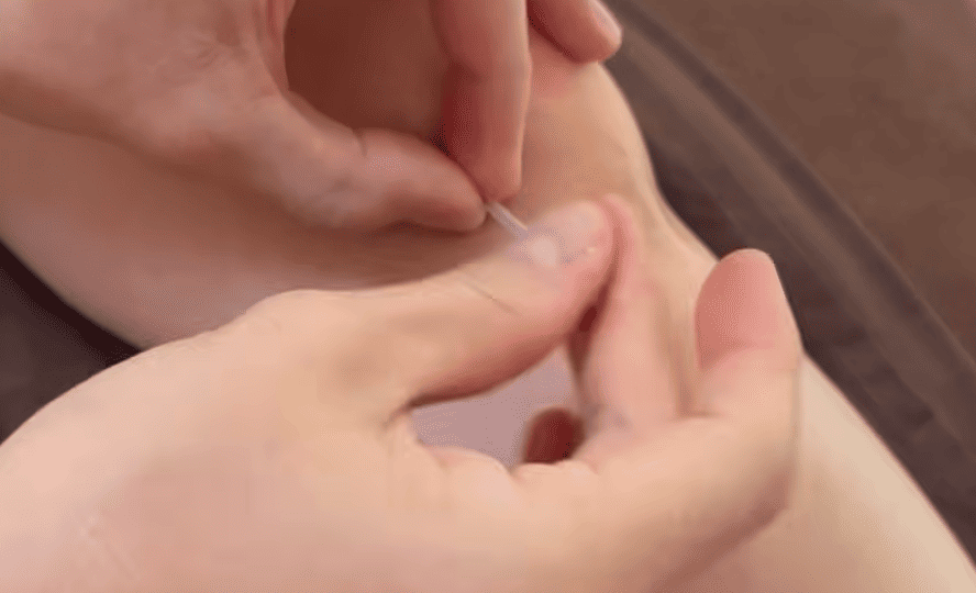 半月板損傷の鍼