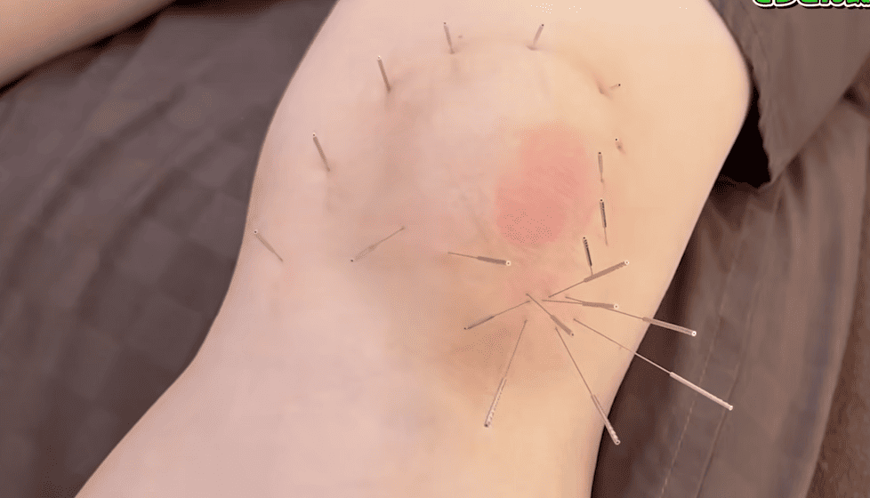 内側半月板損傷