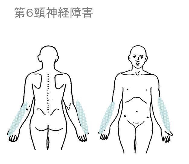 頸椎椎間板ヘルニア