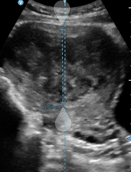 子宮筋腫の鍼灸