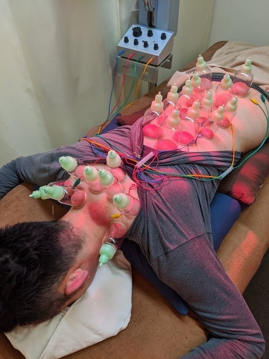 吸玉 銀座そうぜん鍼灸院 深層筋 自律神経 銀座 築地