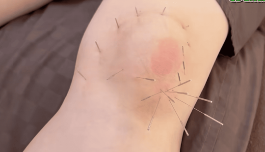 内側半月板損傷